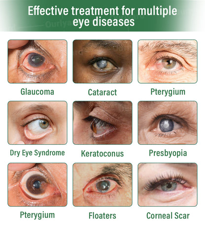 👨🏻‍⚕️Ourlyard® OptiClear DualTech Eye Drops ✅️ MHRA approved | Supports Presbyopia, Dry Eyes, Glaucoma & Cataracts 🍀